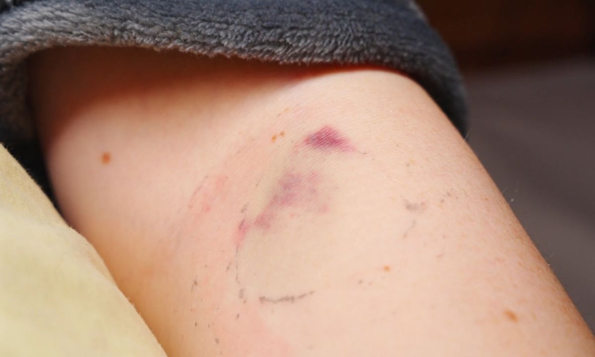 prikaz modrica na telu